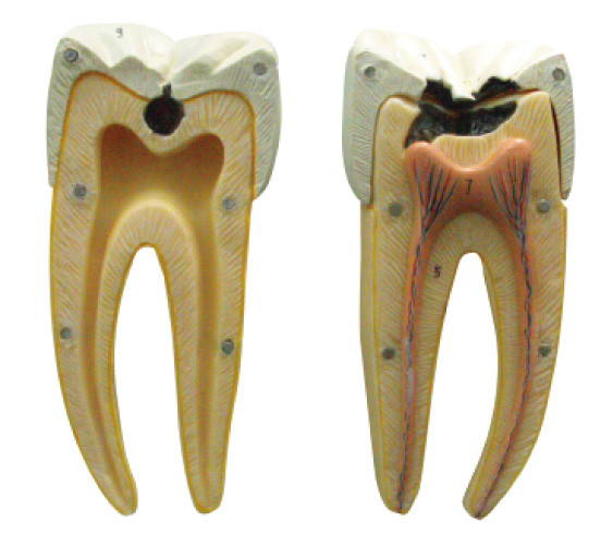 Na inicial e em fases avançadas do modelo da cárie dental para aprender e treinar