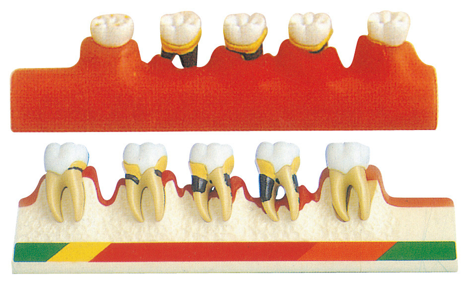 O modelo da doença peridental inclui 5 porções para a formação das escolas dentais