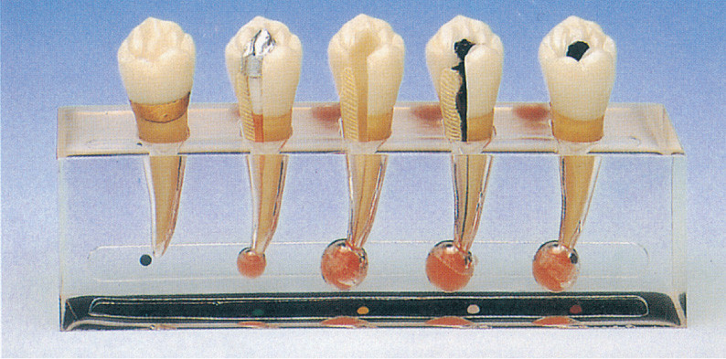 O modelo clínico da patologia da endodontia inclui 5 porções para o treinamento da clínica