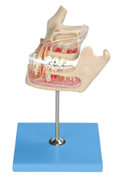 Modelo humano patológico dos dentes/modelo da maxila com o colorimétrico pelo computador aproximadamente duas porções