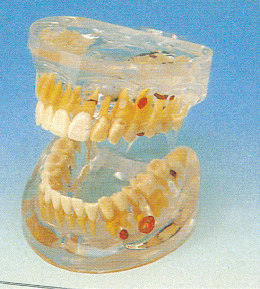 Modelo humano dos dentes da patologia dental transparente adulta para a formação das faculdades