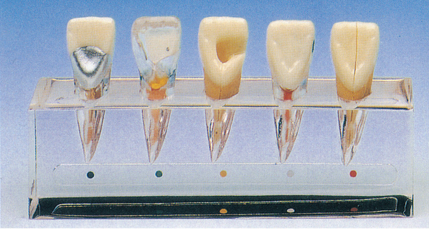 Modelo clínico da série da doença do dente aproximadamente 5 porções para a formação das escolas dentais