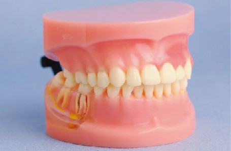 Modelo do modelo humano dos dentes da doença peridental para faculdades médicas e treinamento da clínica